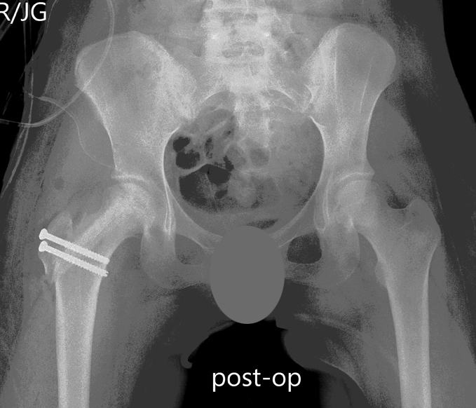 Immediate post-operative X-ray demonstrating appearance of the right hip after open femoral head debridement and bone grafting treatment with no external fixation needed