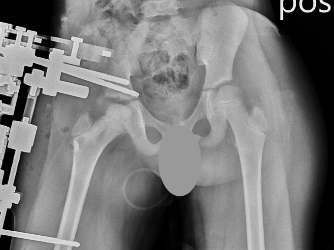 Postoperative X-ray of the right hip being protected by an external fixation device and maintaining no pressure on the round femoral head