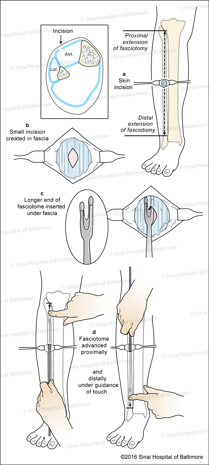 Prophylactic Anterior Compartment Fasciotomy: A, Skin incision; B, Fascial incision; C, Longer end fasciotome inserted under fascia; D, Fasciotome is advanced proximally and distally under guidance of touch.