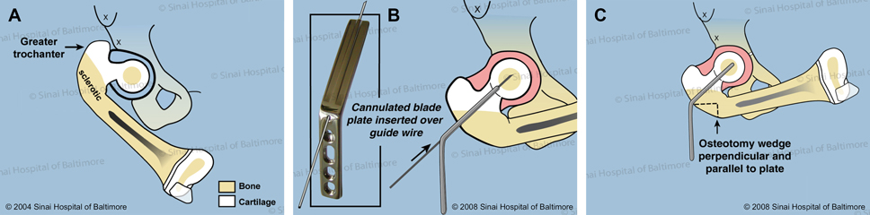 A. This is a patient with congenital femoral deficiency with delayed bone formation in the neck of the femur. B. A blade plate is inserted into the center of the femoral head over a wire. C. In the first osteotomy (bone cut), a triangular piece of bone is removed from the side of the femur.