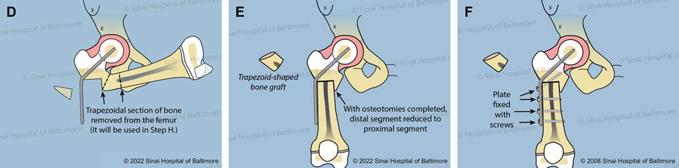 D. The second bone cut removes a trapezoid-shaped piece of bone. E. The two ends of the femur are joined, and the orientation of the femur and knee is normalized. F. The femur shaft is secured to the plate with screws.