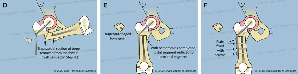 D. The second bone cut removes a trapezoid-shaped piece of bone. E. The two ends of the femur are joined, and the orientation of the femur and knee is normalized. F. The femur shaft is secured to the plate with screws.