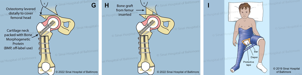 G. A channel in the bone is created parallel to the blade plate, and it is filled with bone morphogenetic protein (BMP). This off-label use of BMP stimulates the growth of new bone. A Dega osteotomy is performed to provide coverage to the femoral head. H. The trapezoid-shaped bone graft, taken from the earlier bone cut (D.), is used to stabilize the Dega osteotomy. I. A spica cast is used to protect the bone for six weeks while the bone heals.