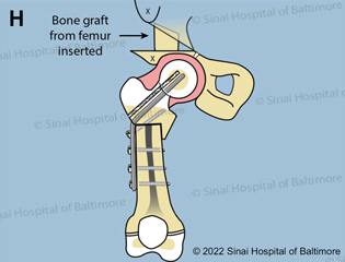 H. The trapezoid-shaped bone graft, taken from the earlier bone cut (D.), is used to stabilize the Dega osteotomy.