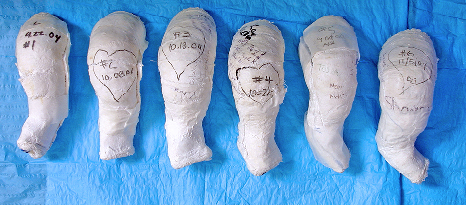 A series of casts used for treatment of clubfoot