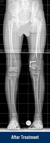 An X-ray of a patient's legs after treatment for a severe developmental bone deformity, showing her legs are now straightened