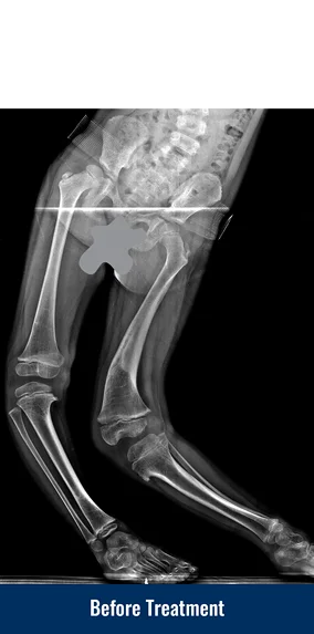 An X-ray of a patient's legs showing a severe developmental bone deformity