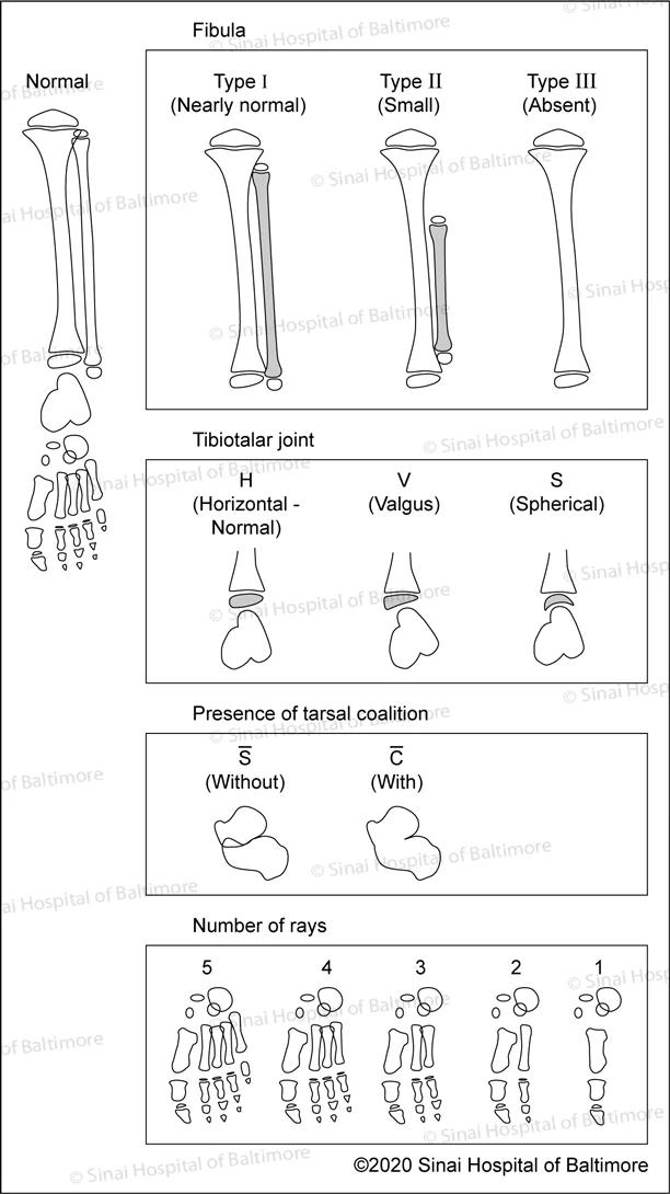 Stanitski Classification of Fibular Hemimelia: Type I Type II and Type III; Tibiotalar Joint: Horizonal, normal; valgus,; spherical; presence of tarsal coalition: With and without; Number of rays: 1–5
