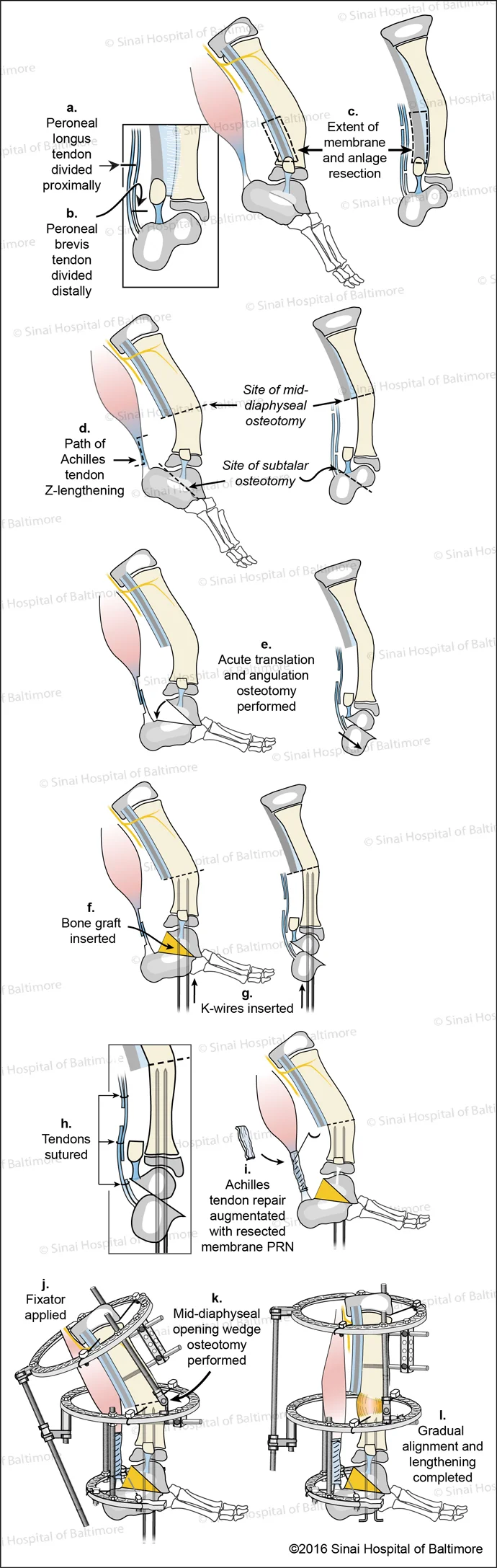 SUPERankle Surgical Technique for Subtalar Type Fibular Hemimelia (Paley Type 3B) Fig. A, Peroneal longus tendon is divided proximally. B, Peroneal brevis tendon is divided distally. C, The extent of the membrane and anlage resection is identified. D, The path of the Achilles tendon Z-lengthening and site of mid-diaphyseal and subtalar osteotomies are identified. E, Acute translation and angulation osteotomy are performed. F, Bone graft is inserted; G, K-wires are inserted; H, Tendons are sutured; I, Achilles tendon repair is augmented with resected membrane as needed; J, The external fixator is applied; K, A mid-diaphyseal opening wedge osteotomy is performed; L, Gradual alignment and lengthening is completed.