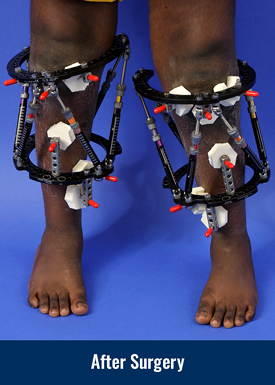Success Nworisa after surgery for blount disease and bowlegs, showing his legs straightened with external fixators applied to them.