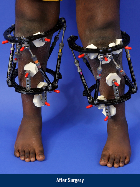 Success Nworisa after surgery for blount disease and bowlegs, showing his legs straightened with external fixators applied to them.