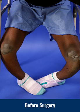 Success Nworisa before surgery for blount disease and bowlegs, showing his legs severely bowed.