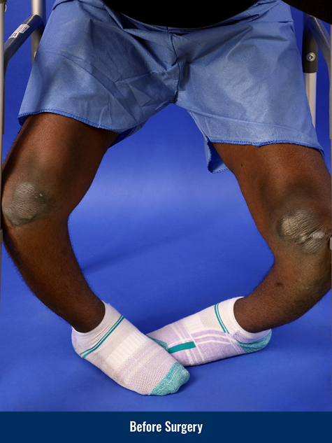 Success Nworisa before surgery for blount disease and bowlegs, showing his legs severely bowed.