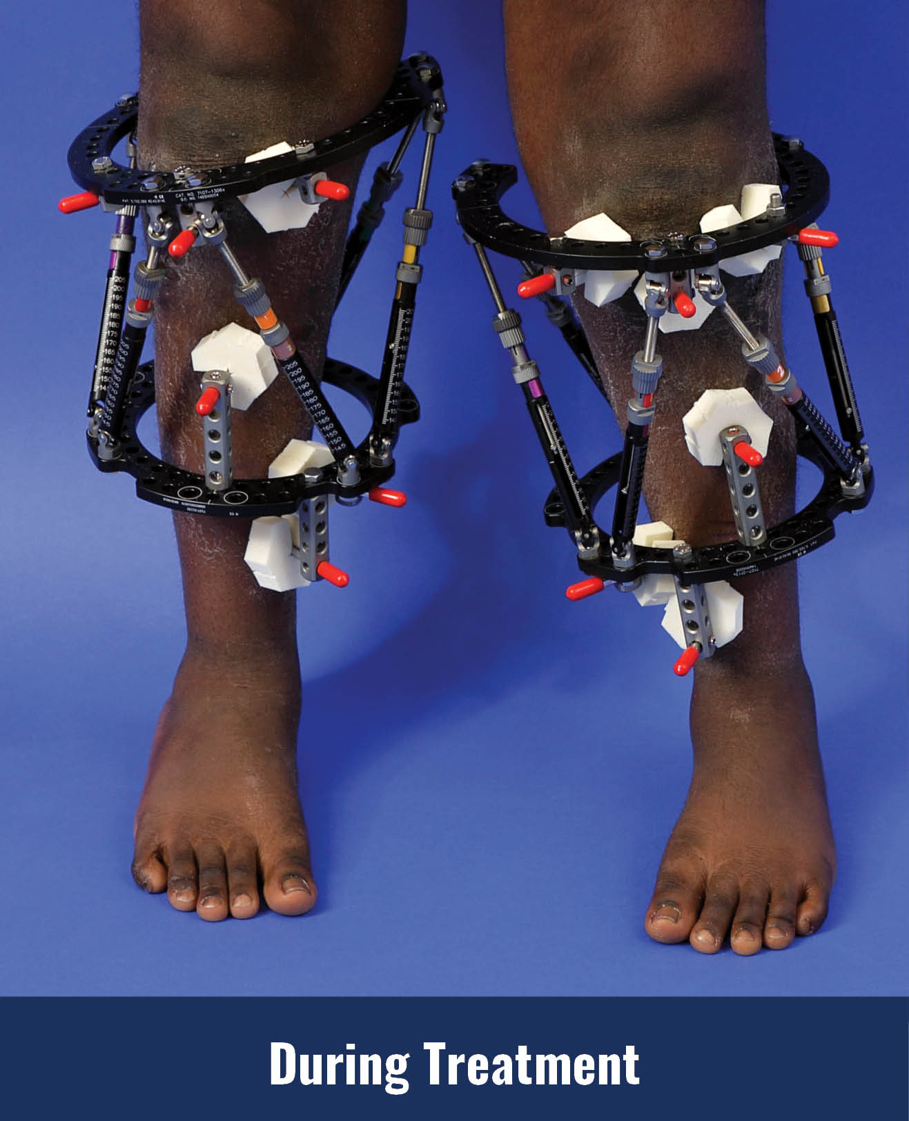 Success after surgery for Blount disease and bowlegs, showing his legs straightened with external fixators applied to them.