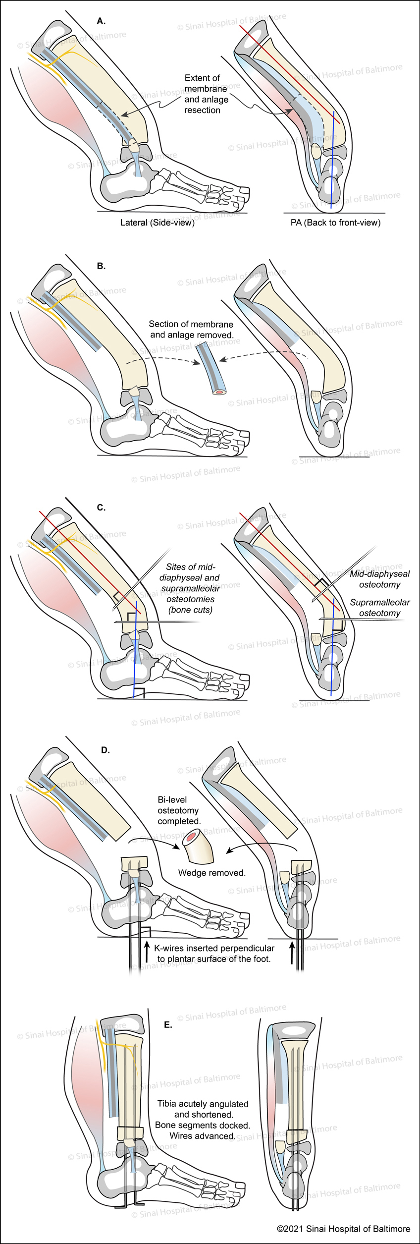 SUPERankle Surgical Technique for Supramalleolar Type Fibular Hemimelia (Paley Type 3A - ankle type) Fig. A, AP View, Peroneal longus tendon is divided proximally. B, AP View, Peroneal brevis tendon is divided distally. C, Lateral and AP views, The extent of the membrane and anlage resection is identified; D, E, AP and Lateral views, Path of Achilles tendon Z-lengthening, sites of mid-diaphyseal and supramalleolar osteotomies are identified, k-wires are inserted.
