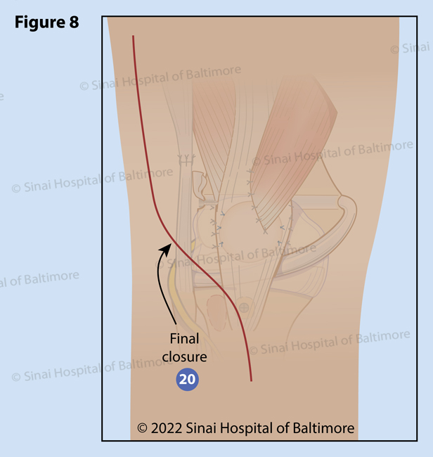Figure 8. The incision is then closed (20). A long leg cast is applied to maintain the knee in a safe position to allow early healing.