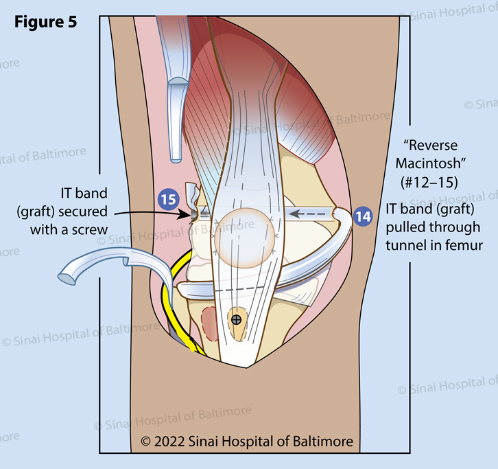 Reverse Macintosh: Figure 4 and 5. Knees with chronic deformities require ligamentous reconstruction to prevent recurrence of rotational dislocation of the knee. The IT band is passed under the patellar tendon (12). A tunnel is drilled through the femur (13). The IT band is pulled through the tunnel in the femur from the medial side (14) to the lateral side of the femur where it is fixed with a bone screw (15).