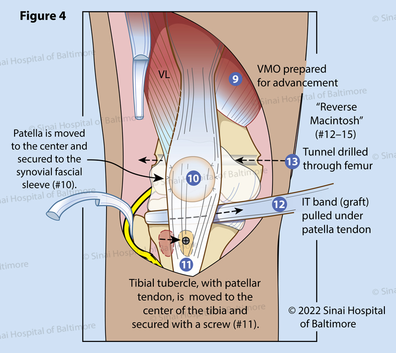 Figure 4. The VMO is isolated for later advancement (9) and transferred medially in most cases to allow a direct line of pull for the patella. The synovial window, opened by moving the patella medially, is closed with suture. An incision in the joint lining over the center of the knee is made, and the patella is transferred into the window (10). At this point, the patella is tracking centrally with flexion and extension. The tubercle is medialized to track (inline) with the synovial window (11).