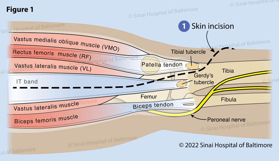 Figure 1. Complete reconstruction of a congenitally dislocated patella requires access to the lateral origin on the quadriceps muscle, the iliotibial (IT) band, the biceps femoris muscle (most posterior and lateral muscle in the thigh), the peroneal nerve, the patella, the patellar tendon and the tibial tubercle, as well as the medial portion of the quadriceps muscle. All of these structures can be accessed through a single incision (1) that begins laterally on the thigh, curves anteriorly just above the joint line and becomes directly anterior over the tibial tubercle. This incision is carried down to the lateral fascia of the thigh and the iliotibial band. The patella is dislocated laterally on the femur and is typically quite small.