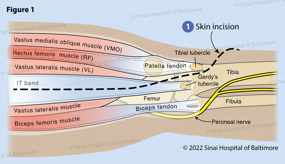 Congenital Dislocation of the Patella: Surgical