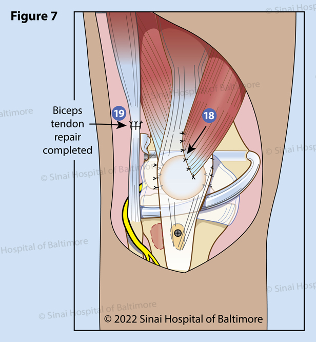 Figure 7. The VMO is repaired to optimize knee mechanics (18). The biceps tendon is repaired in full knee extension (19). The peroneal nerve is monitored while testing knee range of motion. Occasionally the knee cannot be fully extended due to the tightness of the nerve and therapy will be required.