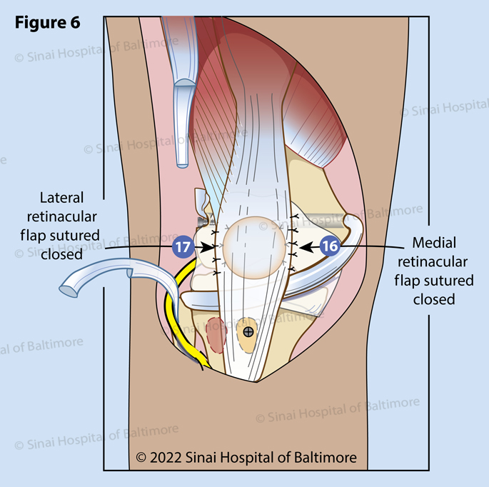 Figure 6. The patella is fixed to the synovium circumferentially (16) (17).