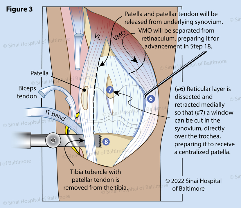 Figure 3. The patella is then isolated and separated from the synovial tissue, allowing transfer of the extensor mechanism (quadriceps tendon, patella, patellar tendon) medially into the center of the knee joint. Meticulous dissection is carried medially, separating the joint lining (synovium) from the overlying retinaculum and the vastus medialis muscle (VMO) (6). A synovial window is opened (7). The tibial tubercle is lifted off of the bone (8).