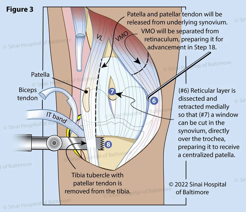 Congenital Dislocation of the Patella: Surgical