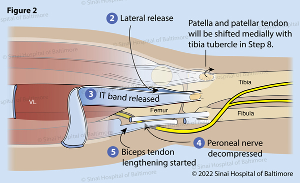 Figure 2. An incision in the fascia is completed anterior and posterior to the thickening of the IT band. (2) The surgeon feels the insertion of the IT band onto the tibia at Gerdy’s tubercle to determine the optimal position of these openings. The IT band is then separated high in the thigh, often through a separate small incision (3). This is protected for later reconstruction for knee stability. The peroneal nerve is identified posterior to the fibular neck and is protected along its course from the posterior thigh to the anterior leg around the fibular neck. Tight tissue bands are released to allow repositioning of the leg without placing undue pressure on the nerve (4). This is particularly important in patients with flexion contractures, knock knees and rotational dislocations of the knee. The biceps tendon is isolated and lengthened in a Z fashion for later repair (5).