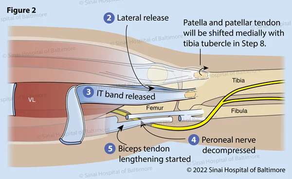 Figure 2. An incision in the fascia is completed anterior and posterior to the thickening of the IT band. (2) The surgeon feels the insertion of the IT band onto the tibia at Gerdy’s tubercle to determine the optimal position of these openings. The IT band is then separated high in the thigh, often through a separate small incision (3). This is protected for later reconstruction for knee stability. The peroneal nerve is identified posterior to the fibular neck and is protected along its course from the posterior thigh to the anterior leg around the fibular neck. Tight tissue bands are released to allow repositioning of the leg without placing undue pressure on the nerve (4). This is particularly important in patients with flexion contractures, knock knees and rotational dislocations of the knee. The biceps tendon is isolated and lengthened in a Z fashion for later repair (5).