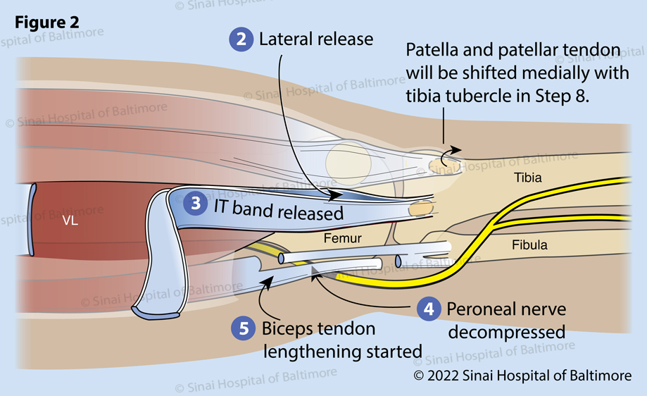Figure 2. An incision in the fascia is completed anterior and posterior to the thickening of the IT band. (2) The surgeon feels the insertion of the IT band onto the tibia at Gerdy’s tubercle to determine the optimal position of these openings. The IT band is then separated high in the thigh, often through a separate small incision (3). This is protected for later reconstruction for knee stability. The peroneal nerve is identified posterior to the fibular neck and is protected along its course from the posterior thigh to the anterior leg around the fibular neck. Tight tissue bands are released to allow repositioning of the leg without placing undue pressure on the nerve (4). This is particularly important in patients with flexion contractures, knock knees and rotational dislocations of the knee. The biceps tendon is isolated and lengthened in a Z fashion for later repair (5).