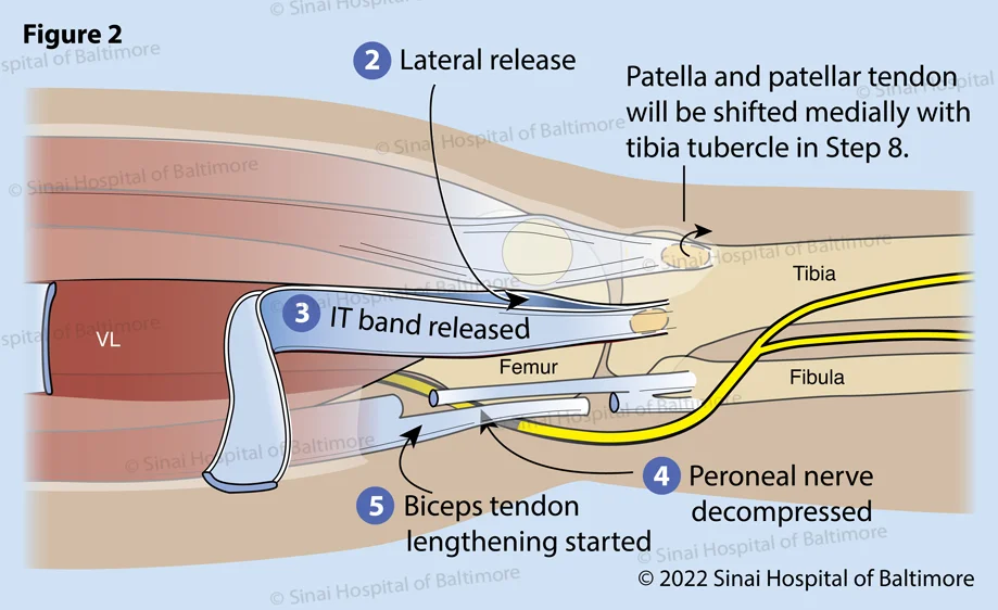 Figure 2. An incision in the fascia is completed anterior and posterior to the thickening of the IT band. (2) The surgeon feels the insertion of the IT band onto the tibia at Gerdy’s tubercle to determine the optimal position of these openings. The IT band is then separated high in the thigh, often through a separate small incision (3). This is protected for later reconstruction for knee stability. The peroneal nerve is identified posterior to the fibular neck and is protected along its course from the posterior thigh to the anterior leg around the fibular neck. Tight tissue bands are released to allow repositioning of the leg without placing undue pressure on the nerve (4). This is particularly important in patients with flexion contractures, knock knees and rotational dislocations of the knee. The biceps tendon is isolated and lengthened in a Z fashion for later repair (5).