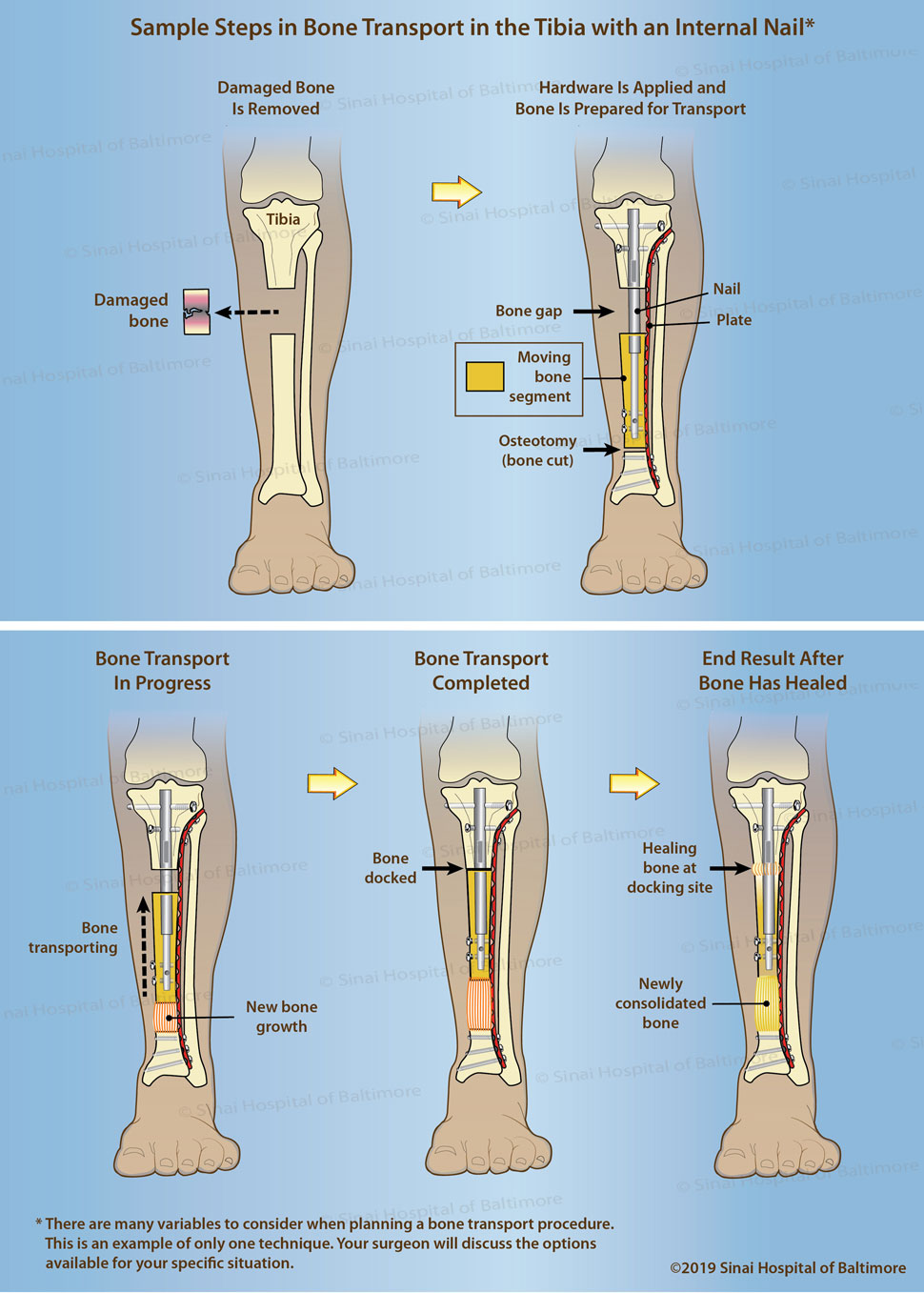 Illustration of a tibia showing the first two steps in bone transport with an internal nail - removing the damaged bone and then applying the hardware to prepare the bone for transport