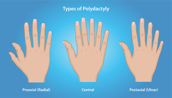 Illustration of three hands showing the various types of Polydactyly: Preaxial (Radial), Central, and Postaxial (Ulnar)