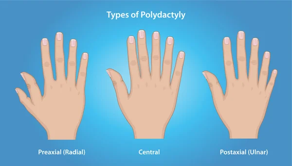 Illustration of three hands showing the various types of Polydactyly: Preaxial (Radial), Central, and Postaxial (Ulnar)