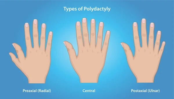 6 Fingers (Polydactylism): Why Are Some People Born With An Extra Digit?