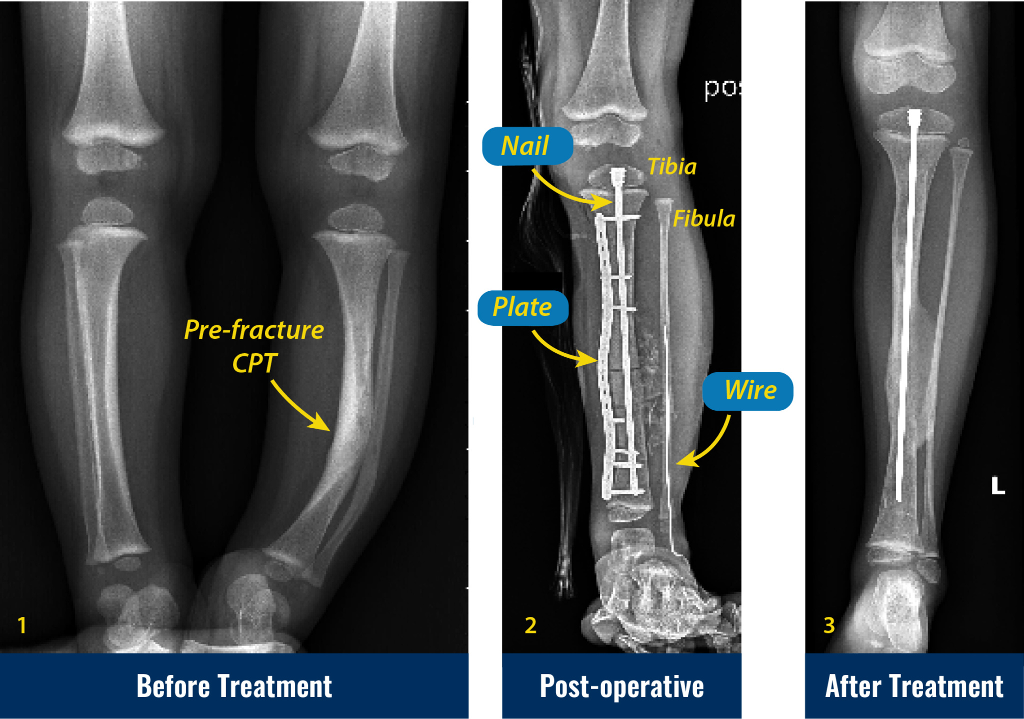 Congenital Pseudarthrosis of the Tibia | International Center for Limb ...