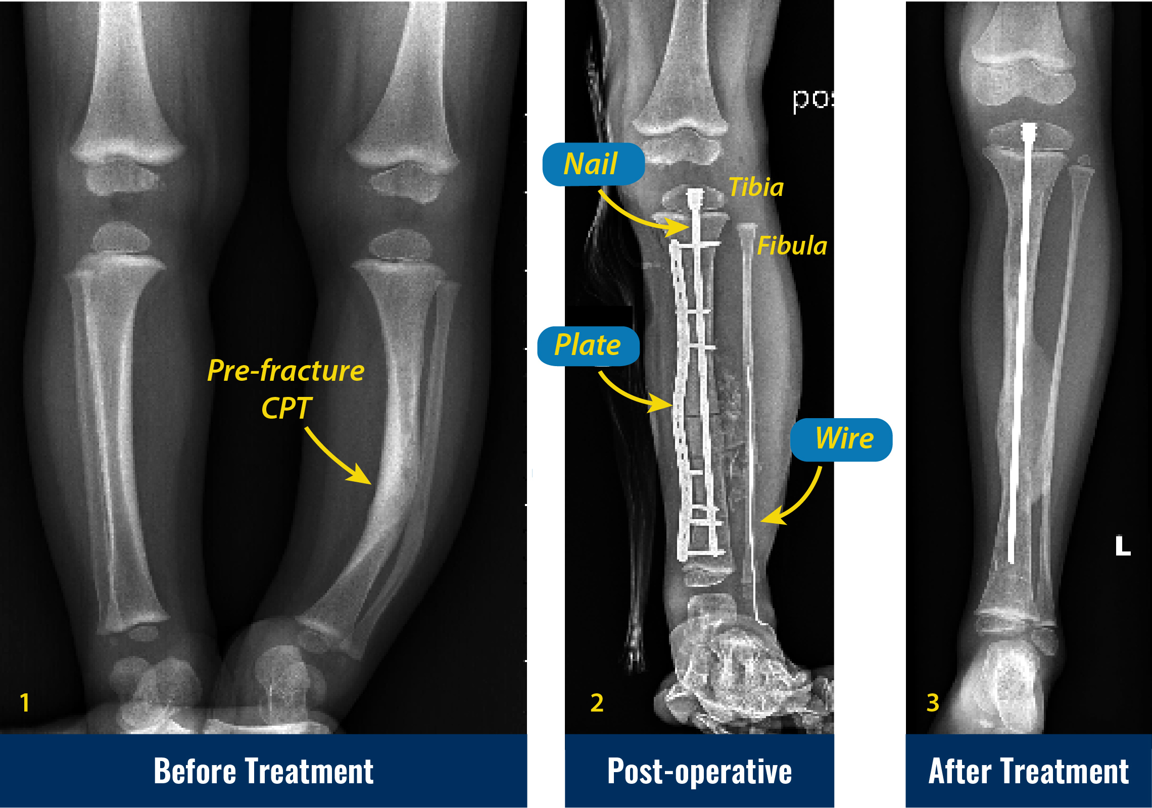 X-rays of “unbroken” congenital pseudarthrosis of the tibia before treatment, after surgery, and after treatment