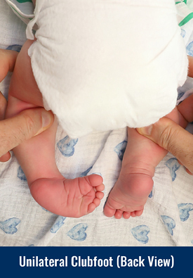 Back view of a baby with unilateral clubfoot