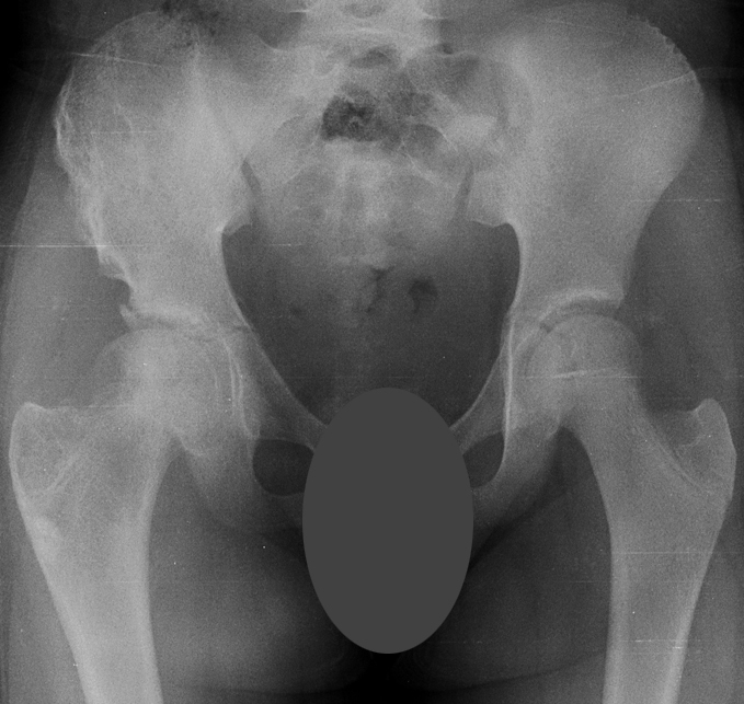 X-ray showing the results at 14 months after the initial treatment with complete healing of the right femoral head, complete resolution of right hip pain and the patient’s full return to activity