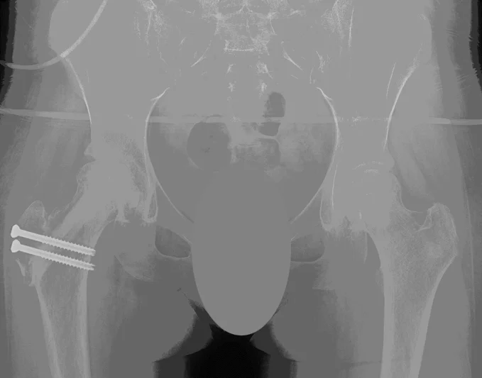 Final healing of right femoral head with resolution of hip pain