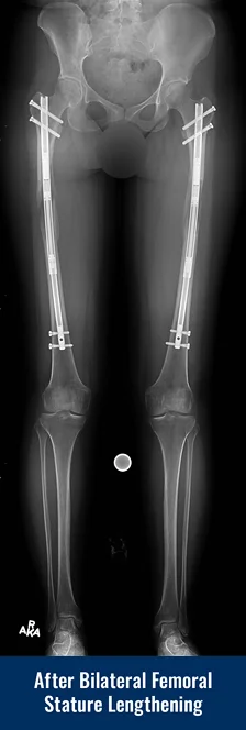 X-ray of a patient's legs after undergoing bilateral femoral cosmetic leg lengthening, showing internal lengthening nails in both femur bones