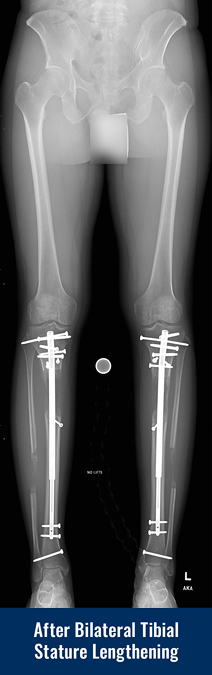 X-ray of a patient's legs after undergoing bilateral tibial cosmetic leg lengthening, showing internal lengthening nails in both tibia bones