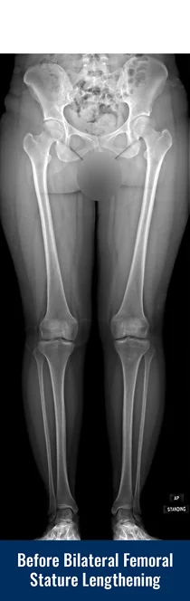 X-ray showing a patient's legs before undergoing bilateral femoral cosmetic leg lengthening