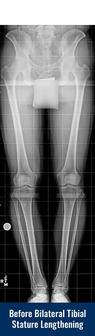 X-ray of a patient's legs before undergoing bilateral tibial cosmetic leg lengthening