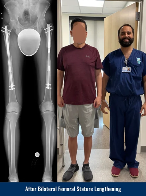 X-ray of a patient's legs after undergoing bilateral femoral cosmetic leg lengthening, showing internal lengthening nails in both femur bones. Photo of the patient standing next to Dr. Michael Assayag 3 months after surgery.