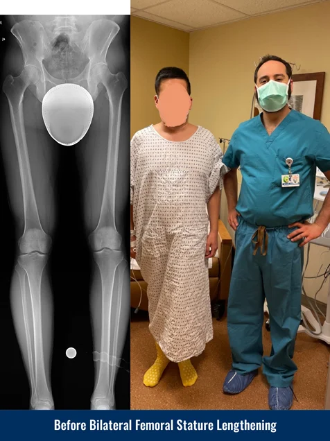 X-ray showing a patient's legs before undergoing bilateral femoral cosmetic leg lengthening. Photo of the patient in a hospital gown standing next to Dr. Michael Assayag before the surgery.