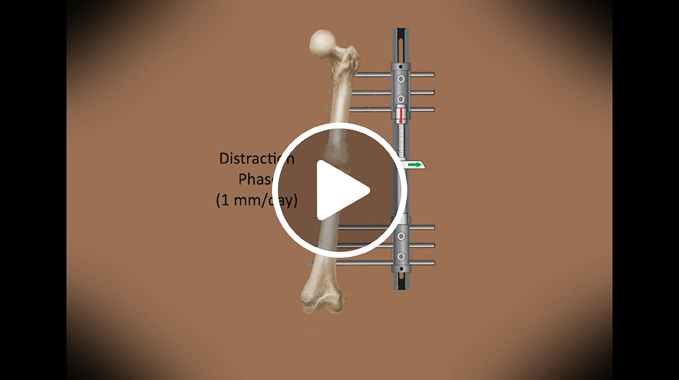 Illustration of how bone lengthening works at the International Center for Limb Lengthening