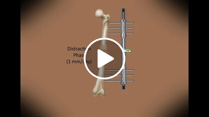 Illustration of how bone lengthening works at the International Center for Limb Lengthening