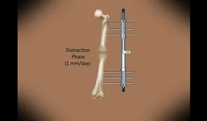 Illustration of how bone lengthening works at the International Center for Limb Lengthening